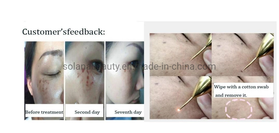 Portable Gold Plasma Pen for Freckle Mole Scar Removal Stretch Mark Removal Fibroblast Device