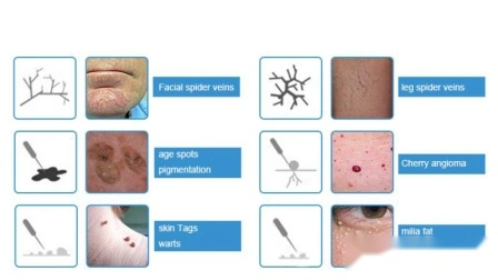 Sistema de terapia de venas varicos multipropósito Ce, máquina facial galvánica de alta frecuencia para eliminación de topos vasculares RF portátil